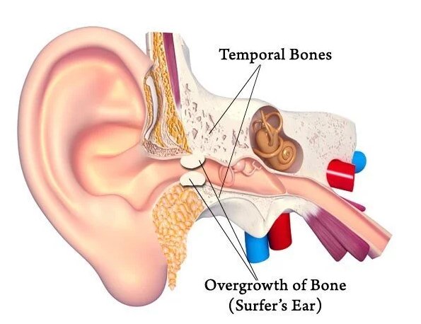 Cross-section illustration of a human ear showing bone overgrowth in the ear canal, known as Surfer's Ear.