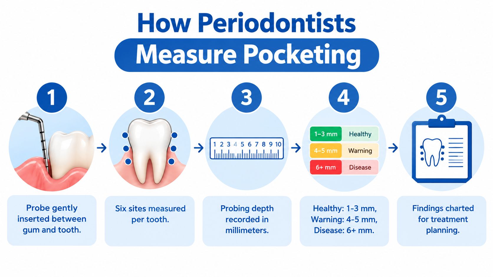 An infographic illustrating the five steps periodontists take to measure gum pocketing around human teeth.