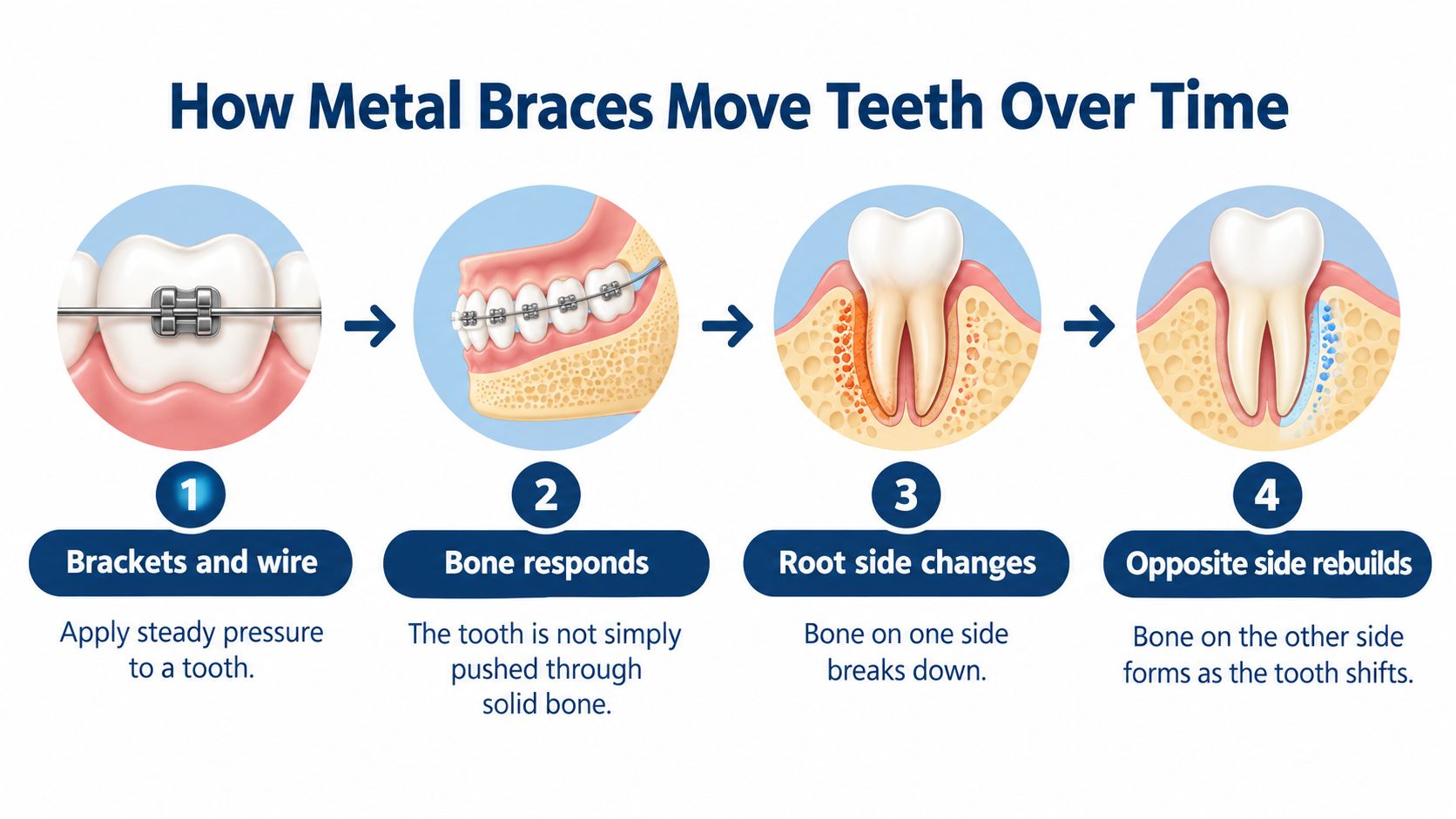 An infographic showing the four-step biological process of how metal braces apply pressure to move teeth.