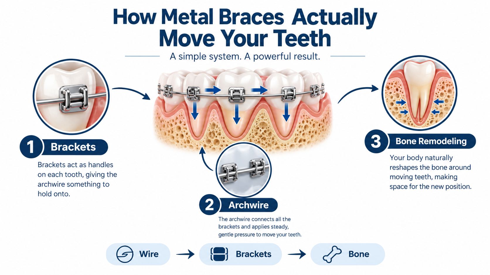 A diagram illustrating the three key components and biological process of how metal braces move teeth.