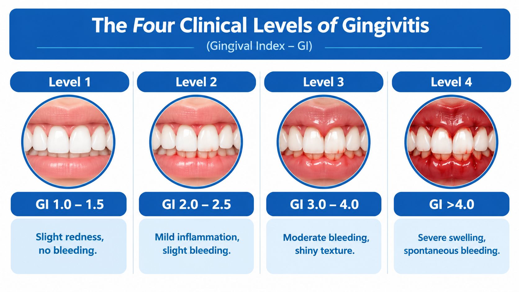 A dental chart illustrating four clinical levels of gingivitis with corresponding visual symptoms and severity indices.