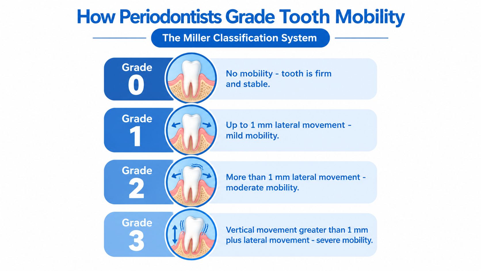 An infographic illustrating the Miller Classification System for grading tooth mobility from Grade 0 to Grade 3.