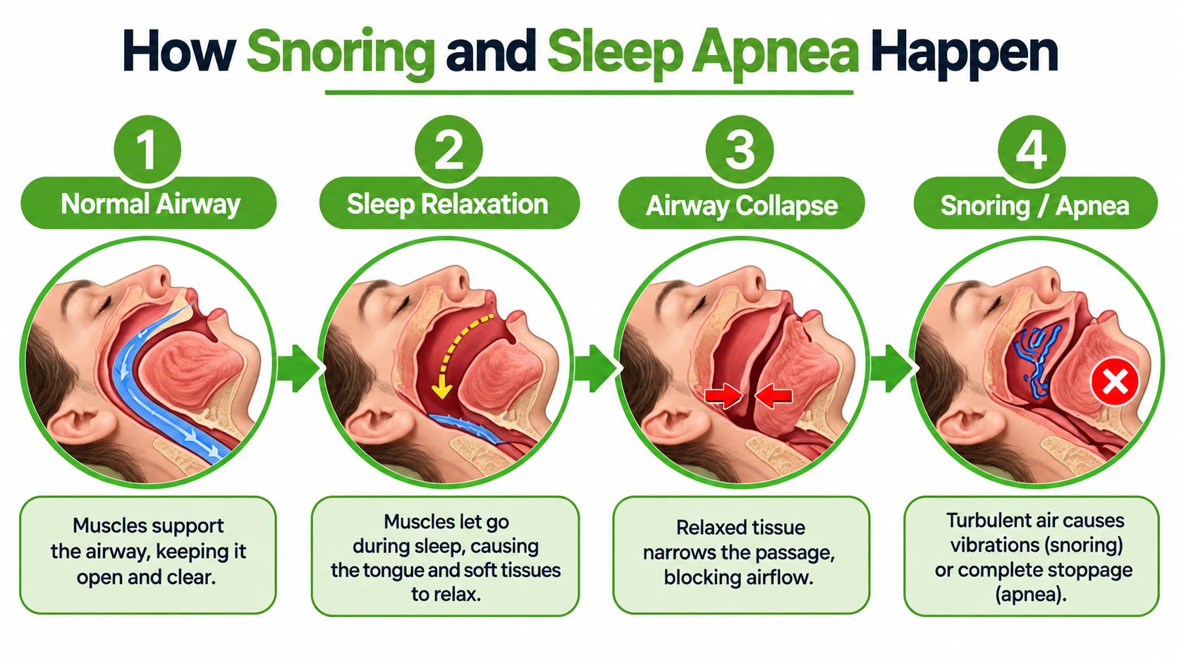 A four-step medical illustration explaining how airway obstruction during sleep leads to snoring and sleep apnea.