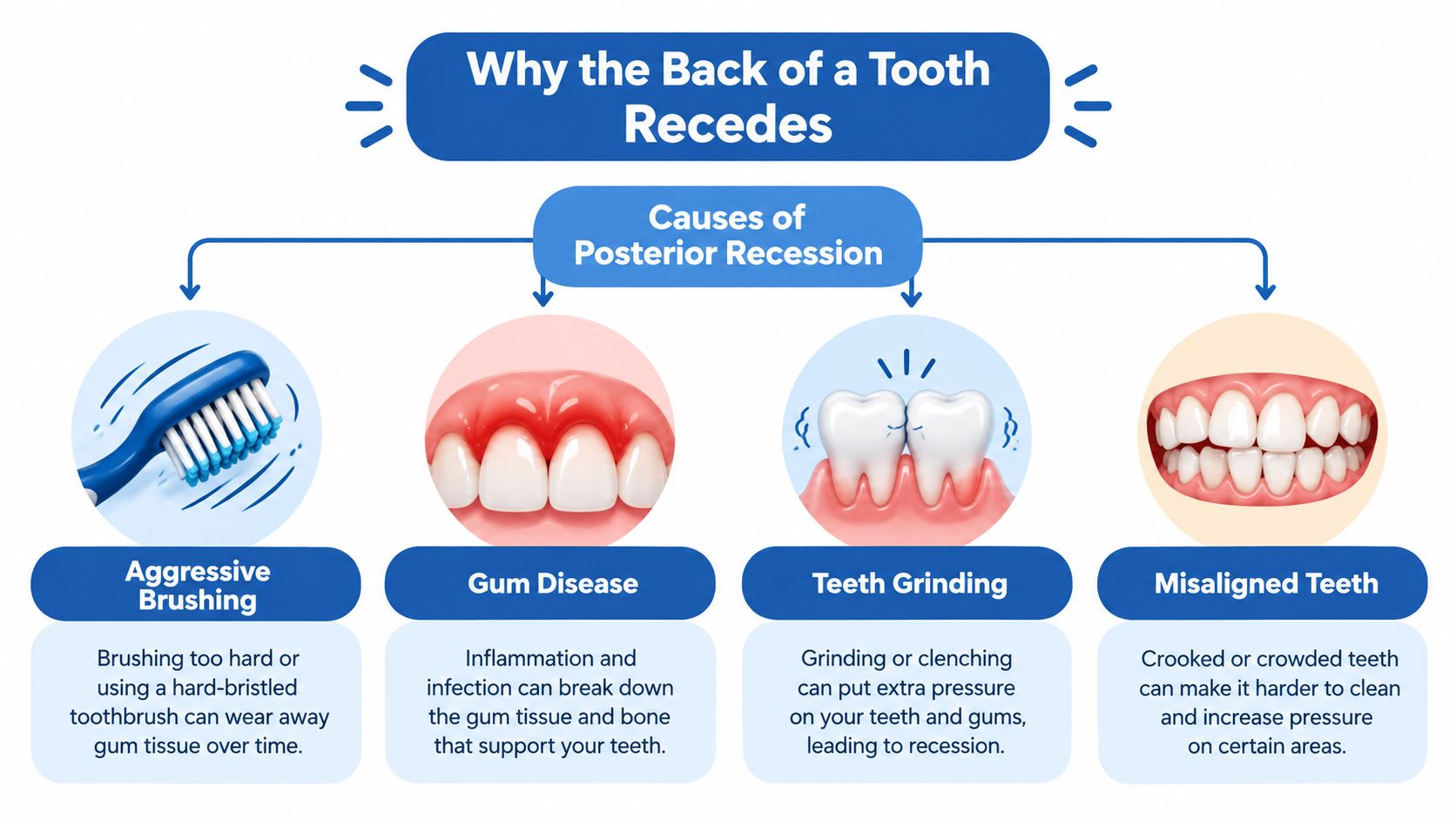 An infographic showing four main causes of receding gums at the back of a tooth.