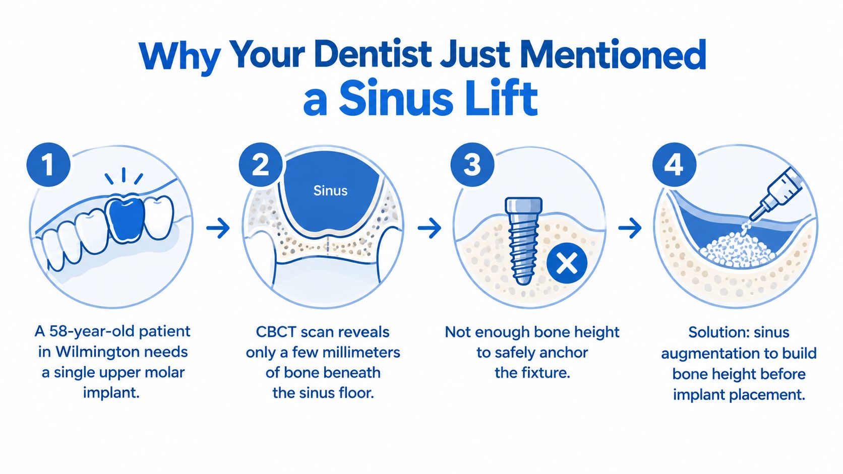 An educational infographic illustrating the four-step dental process for a sinus lift and bone augmentation procedure.