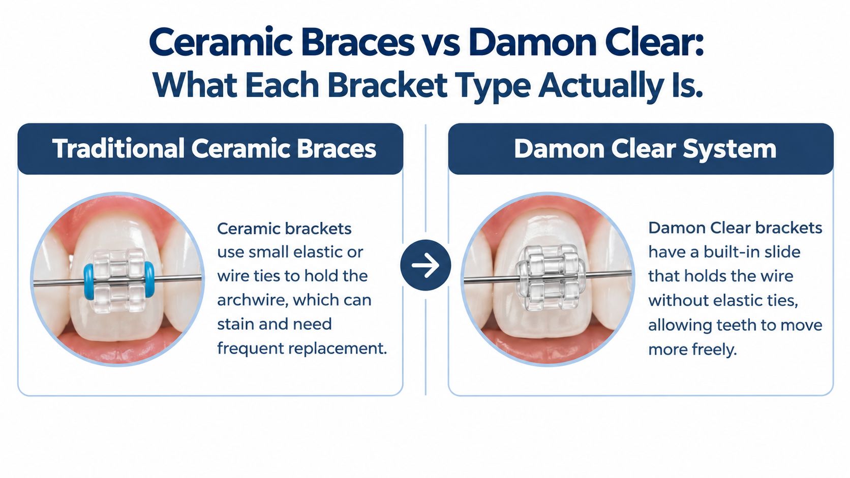 A comparison graphic explaining the differences between traditional ceramic braces with elastic ties and Damon Clear bracket systems.