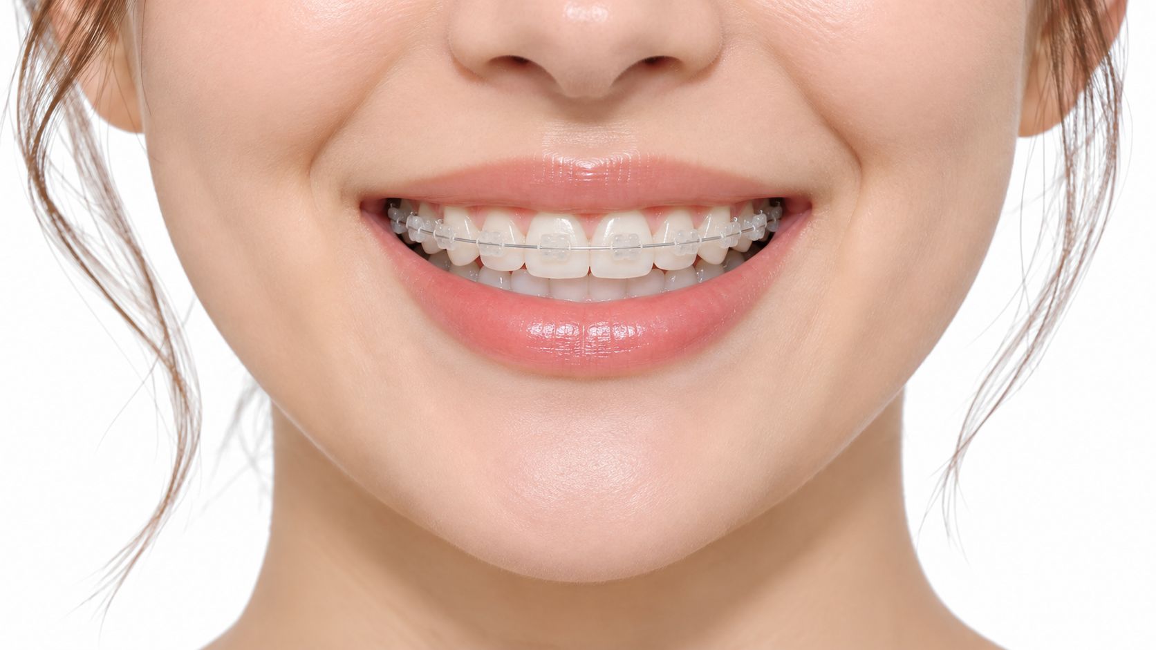 Close-up of a smiling woman with clear braces on her teeth showing the cosmetic results