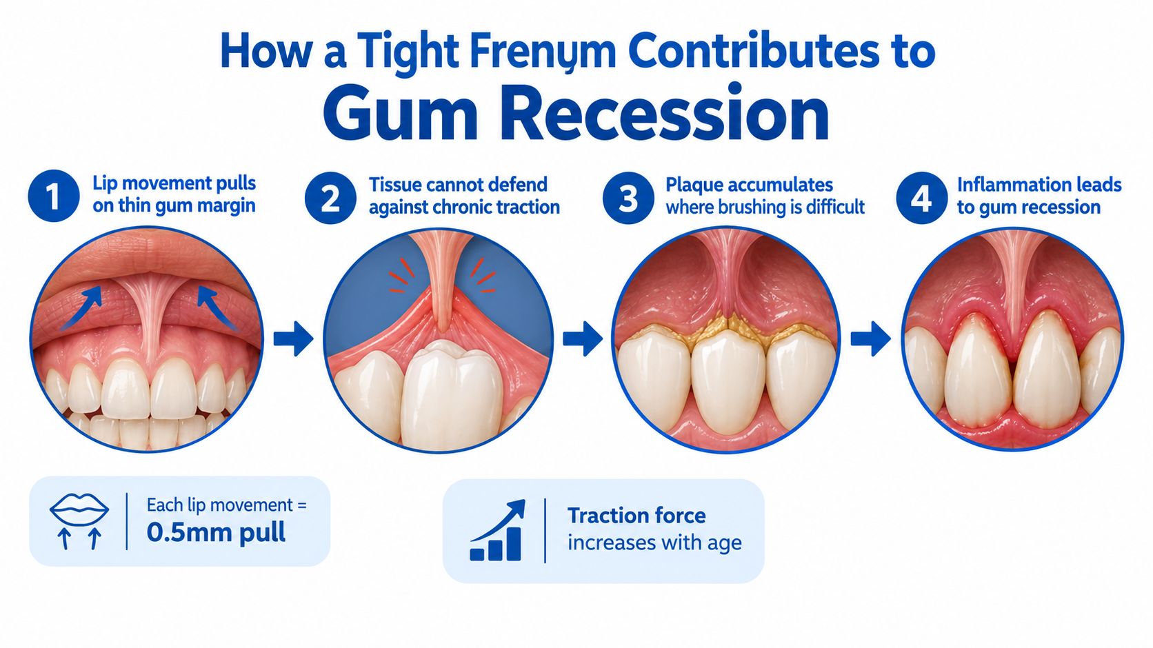 A diagram illustrating how a tight frenum causes gum recession through four steps of physical tissue strain.