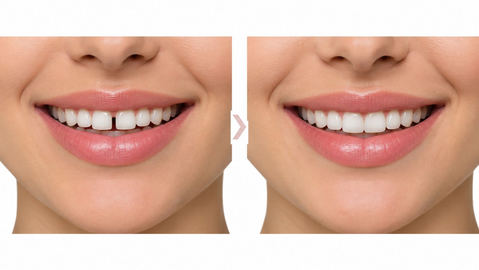 Close-up of a person's smile showing before and after dental treatment for closing a gap between front teeth.