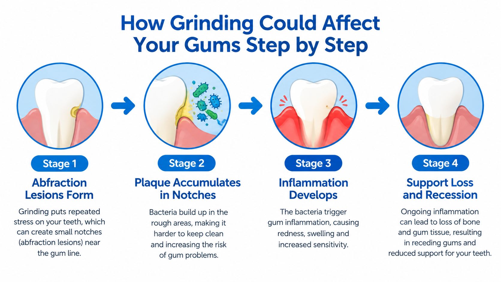 A four-stage infographic showing how teeth grinding causes gum recession and loss of gum support.