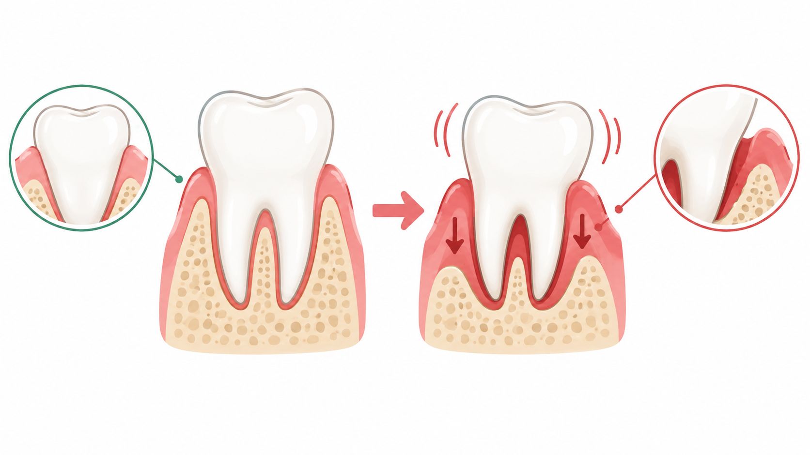 A diagram comparing a healthy tooth with firm gums to a loose tooth with receding gums.
