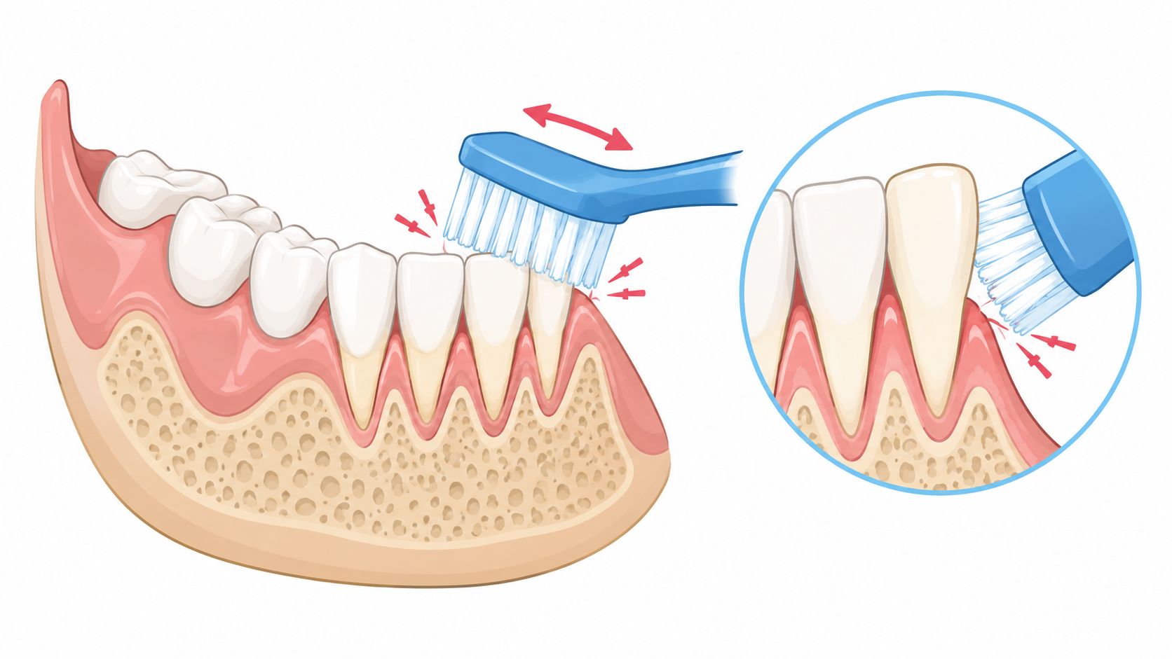 A dental illustration showing improper horizontal toothbrushing causing gum recession and sensitivity on lower teeth.