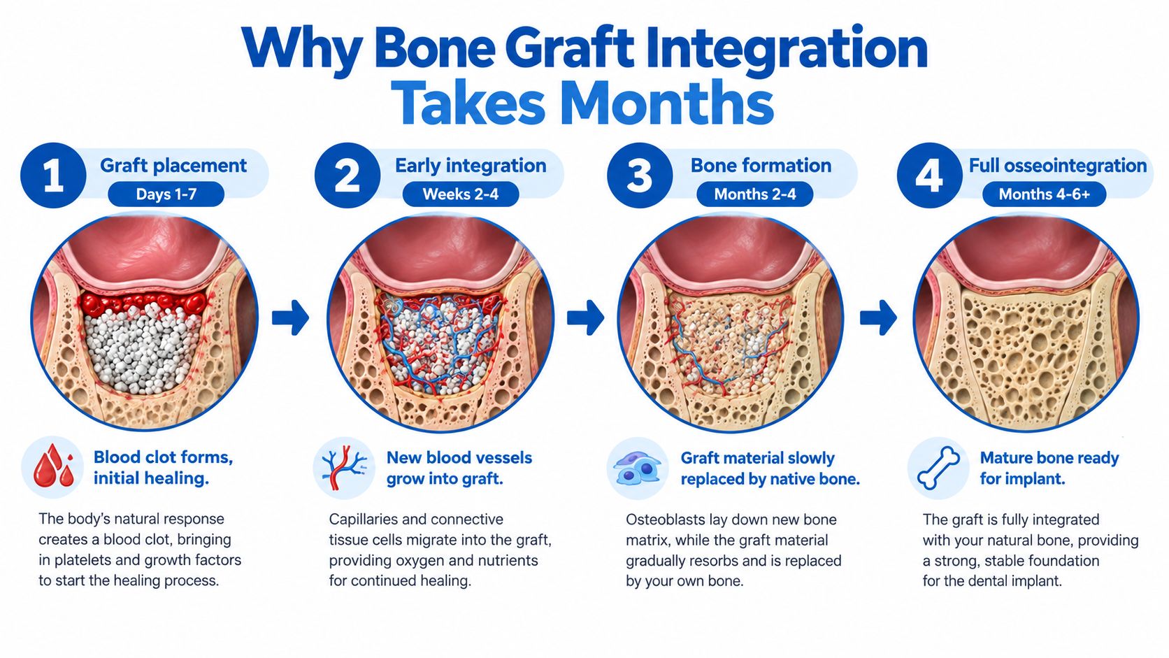 A four-step medical infographic showing the bone graft integration process for a dental sinus augmentation procedure.