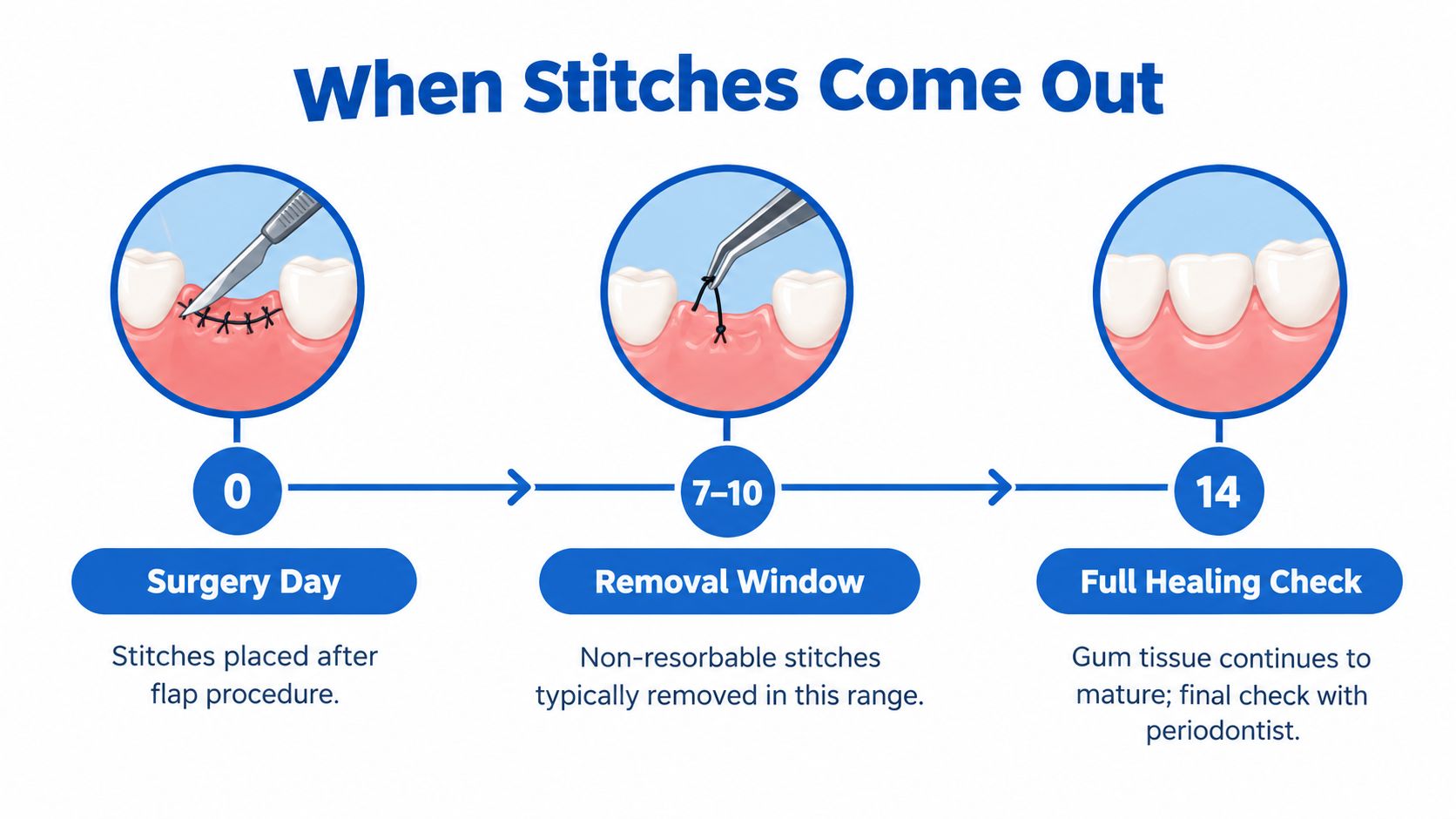 A dental infographic showing a timeline for gum surgery stitches, from placement on day zero to removal.