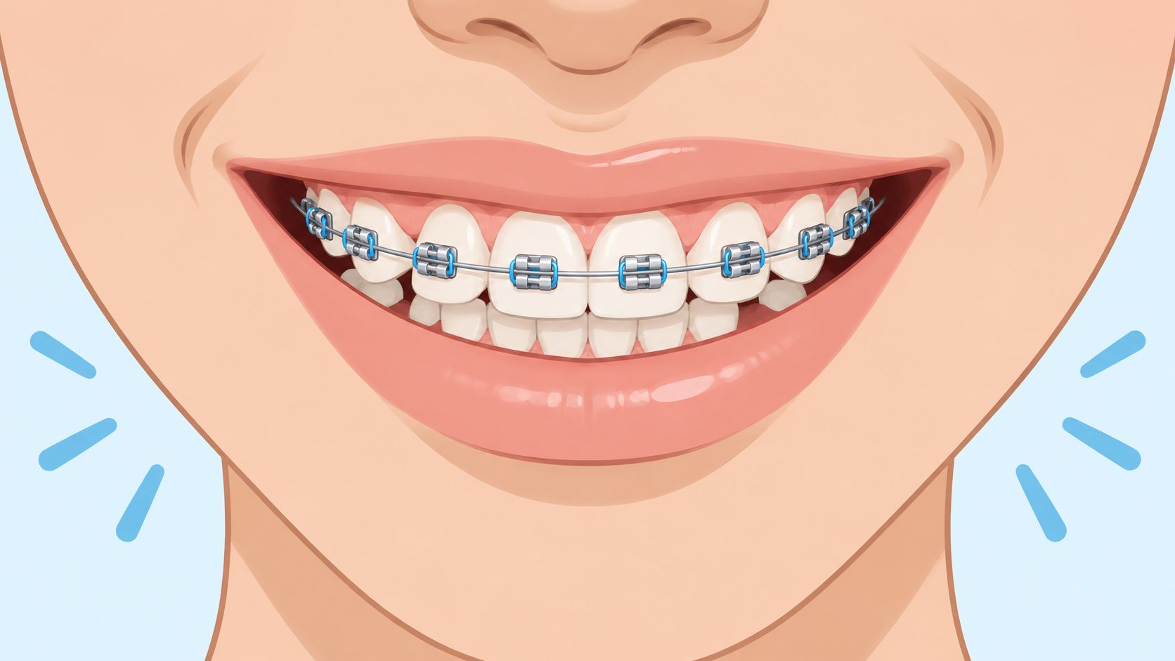 A close-up illustration of a smiling person wearing metal orthodontic braces on their upper teeth.