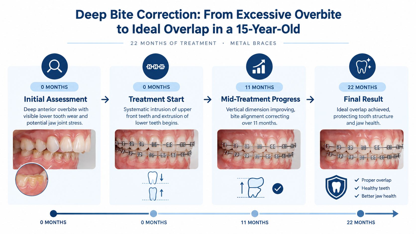 A timeline graphic showing the 22-month orthodontic treatment of a deep bite using metal braces.
