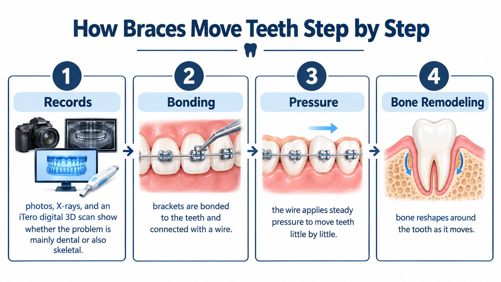 An infographic detailing the four-step process of how dental braces move teeth and remodel bone.