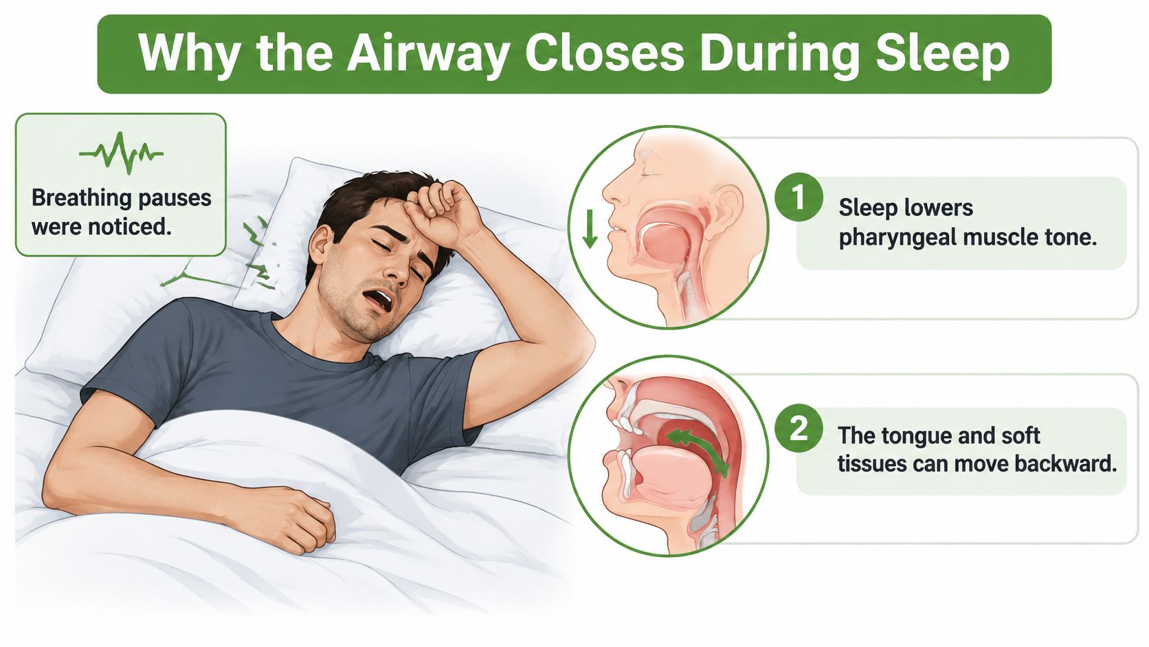 An illustration showing how relaxed muscles and tongue positioning cause airway obstruction during sleep apnea.
