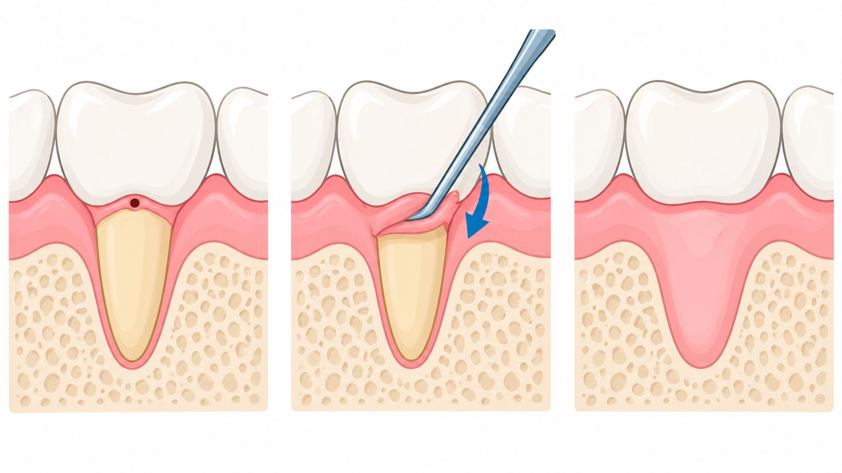 A diagram demonstrating the process of a surgical gum graft procedure to cover exposed tooth roots.