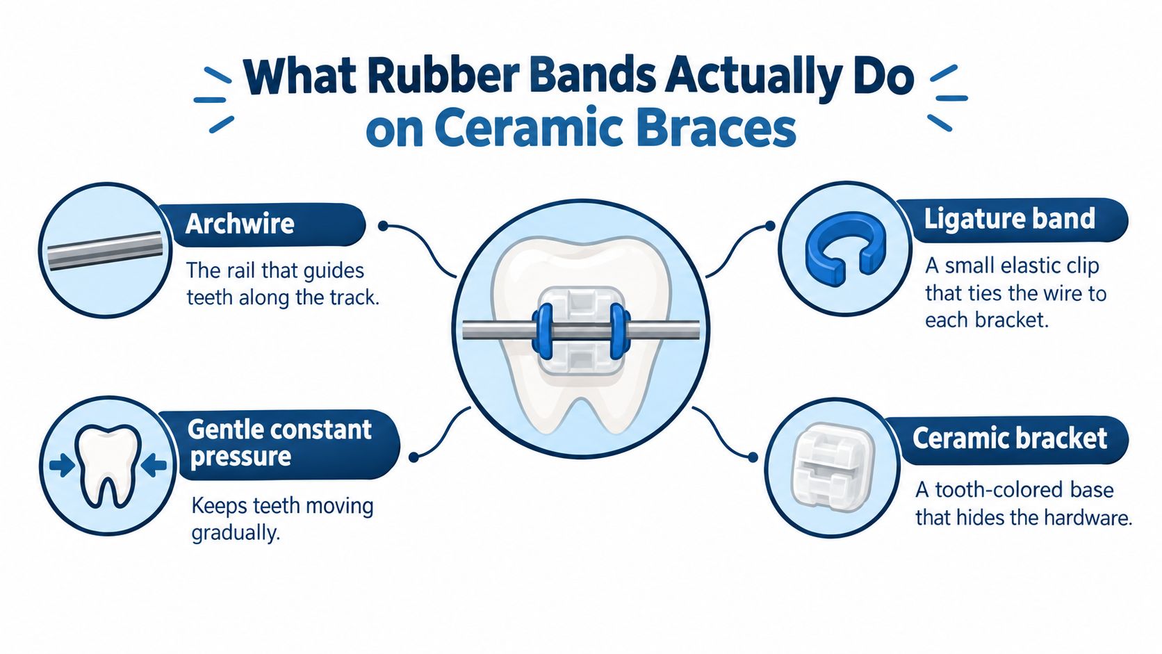 An infographic illustrating how rubber bands, brackets, and archwires function together in ceramic braces for teeth alignment.