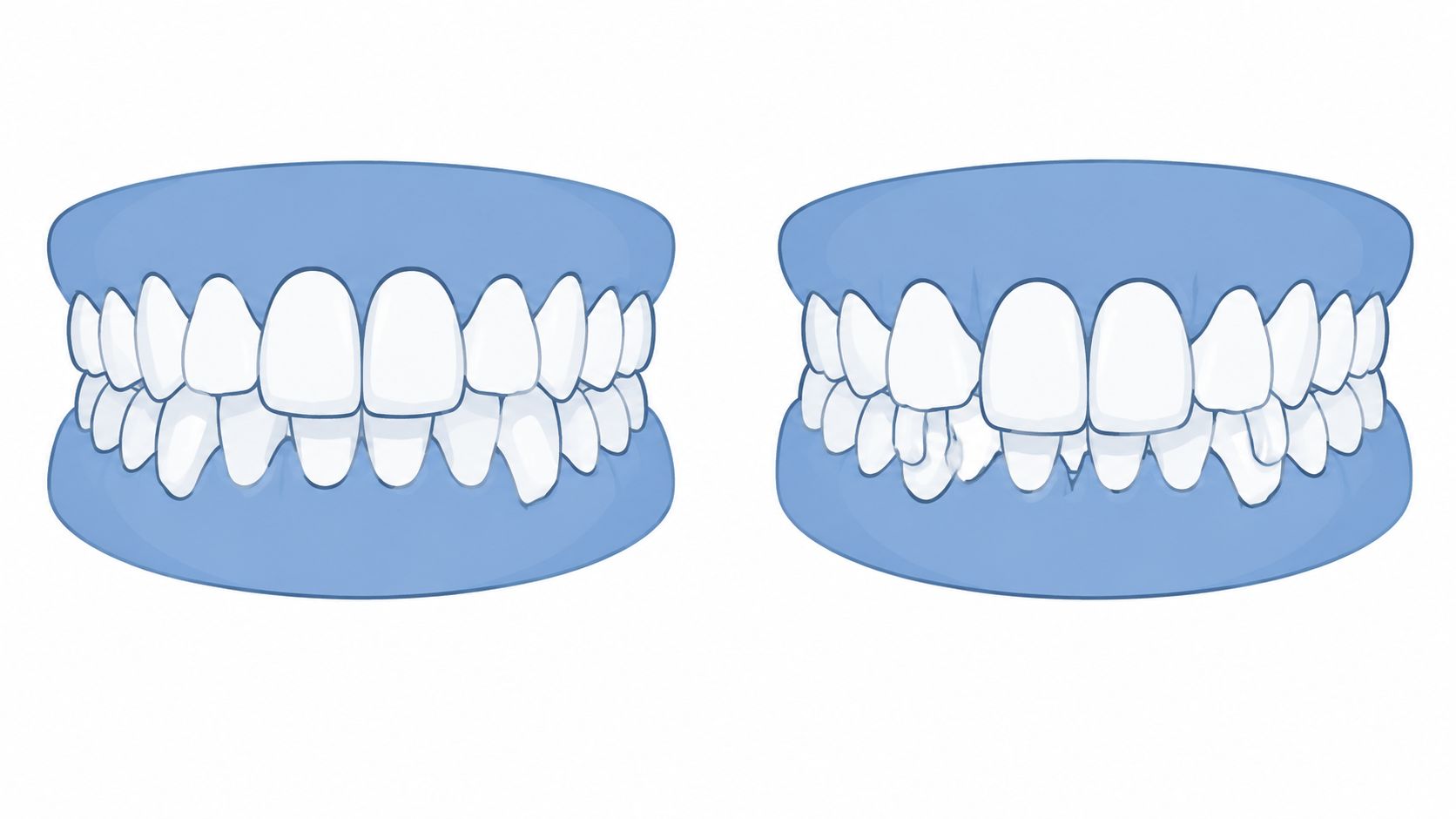 A dental illustration comparing straight teeth on the left with crowded and misaligned teeth on the right.