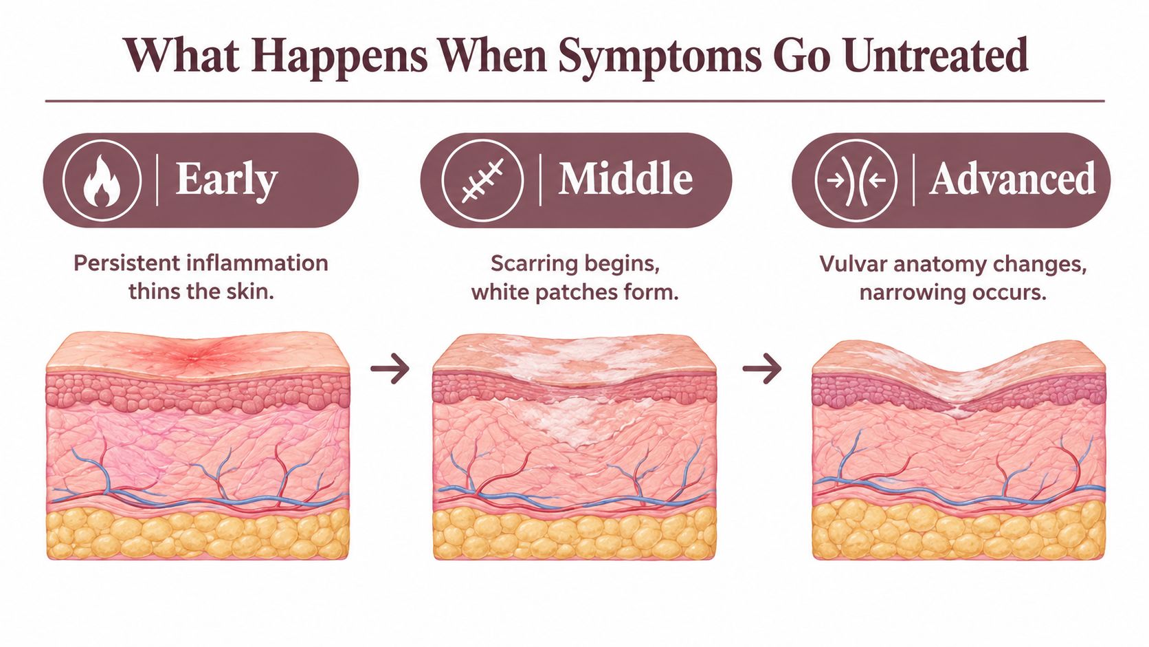 A medical illustration showing three stages of untreated lichen sclerosus: early thinning, middle scarring, and advanced anatomical changes.