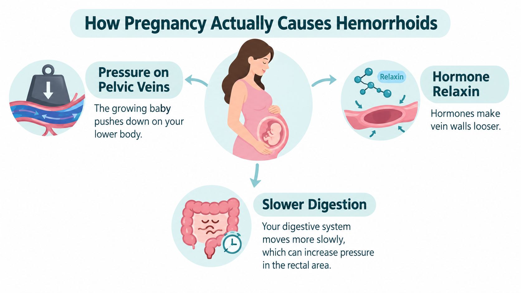 A diagram explaining how pregnancy contributes to hemorrhoids through pelvic pressure, hormone changes, and slower digestion.