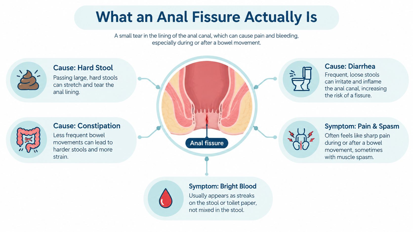 An educational infographic explaining the causes and symptoms of an anal fissure, including pain and bleeding.